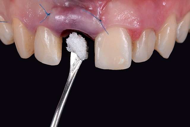 implant-treatment-stage